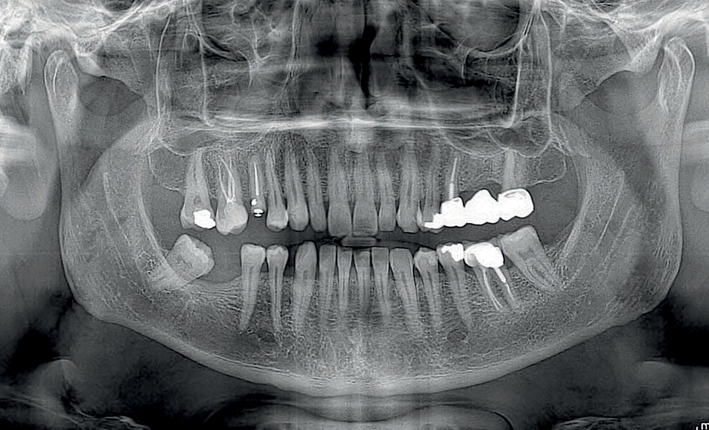 panoráma röntgen felvétel