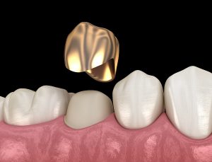 Dr Smile crowns, bridges, dentures and dental implants,