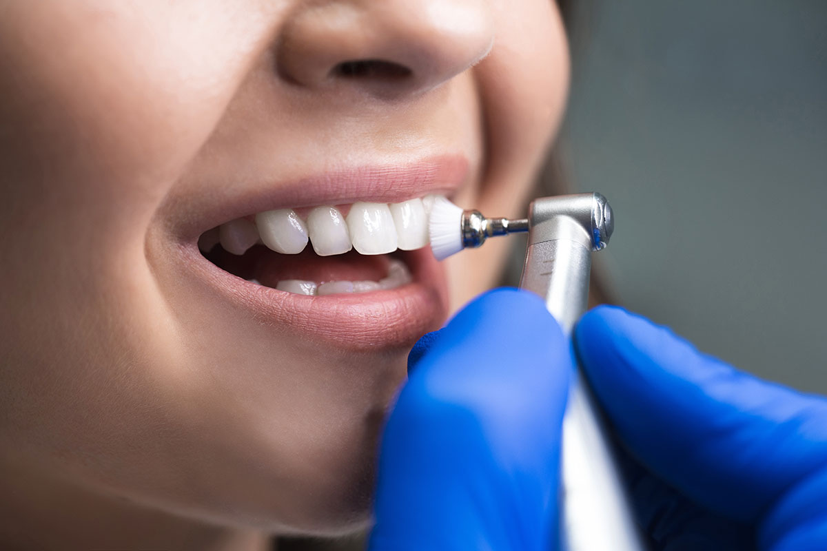Aesthetic dentistry: tartar or tooth stone removal and polish, tooth whitening,