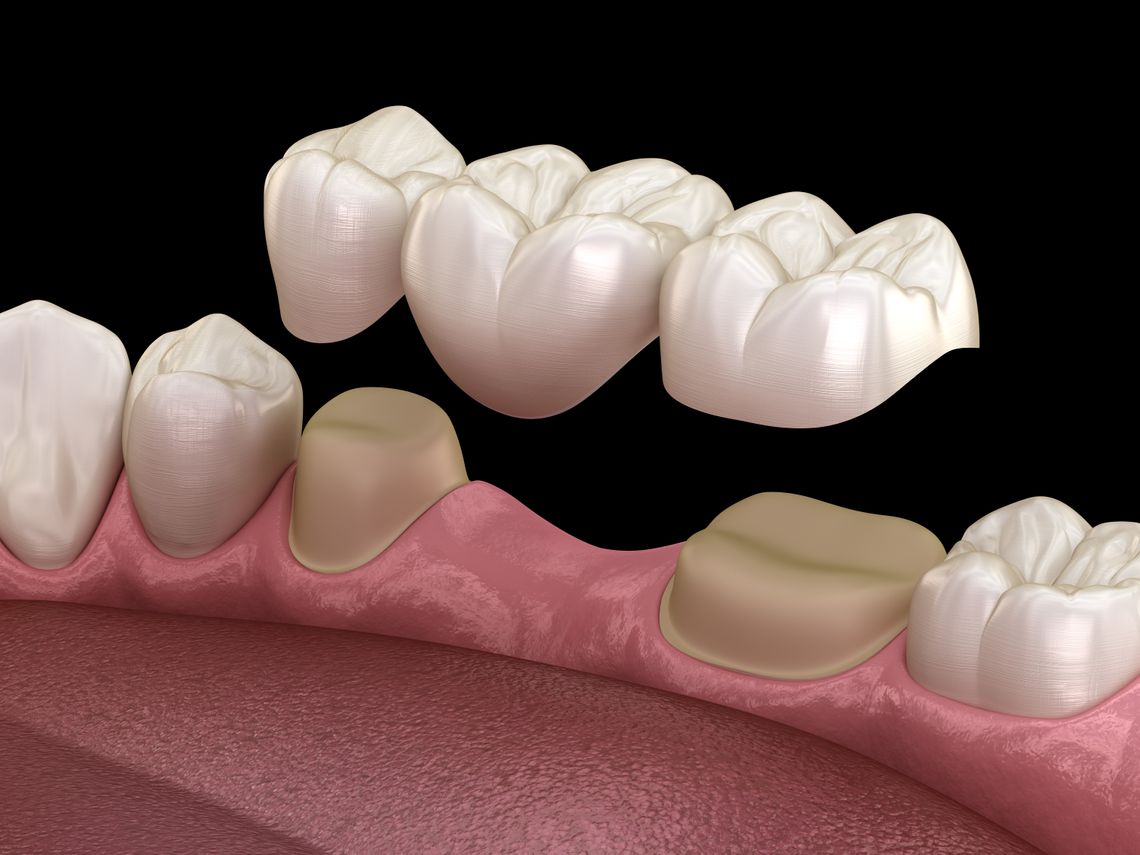 Dr Smile crowns, bridges, dentures and dental implants,