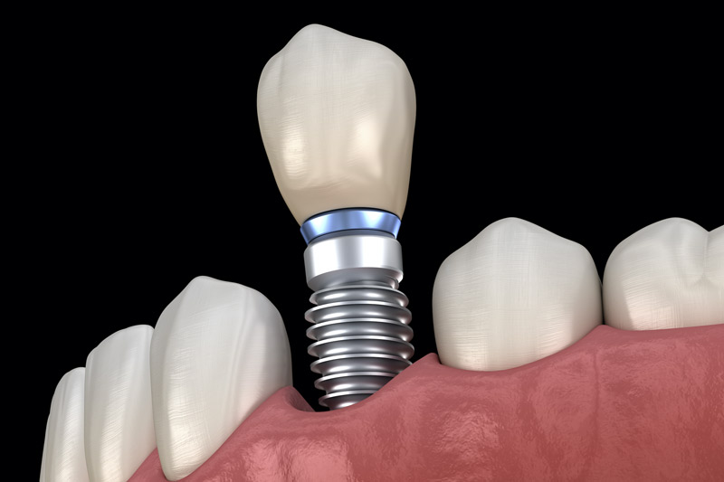Dental implants with a crown, Alpha Bio Implants by Noble biotech. Hungary dental implant treatment at Dr Smile Csopak